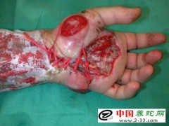 蛇傷口潰瘍、壞死