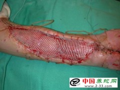 毒蛇咬傷的種類鑒別及診斷